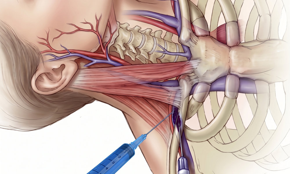 Anatomia del abordaje supraclavicular