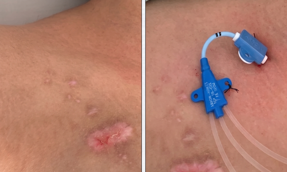 Abordaje supraclavicular